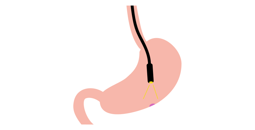 胃カメラ（上部消化管内視鏡）